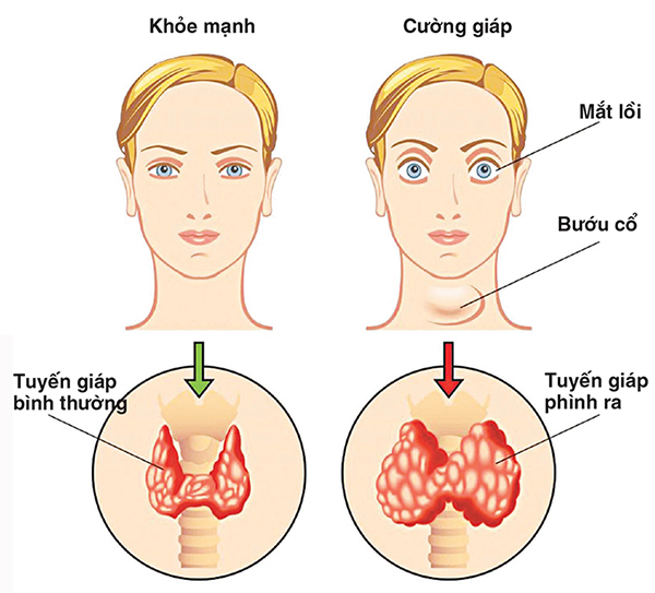 Dấu hiệu toàn thân bệnh nhãn áp.